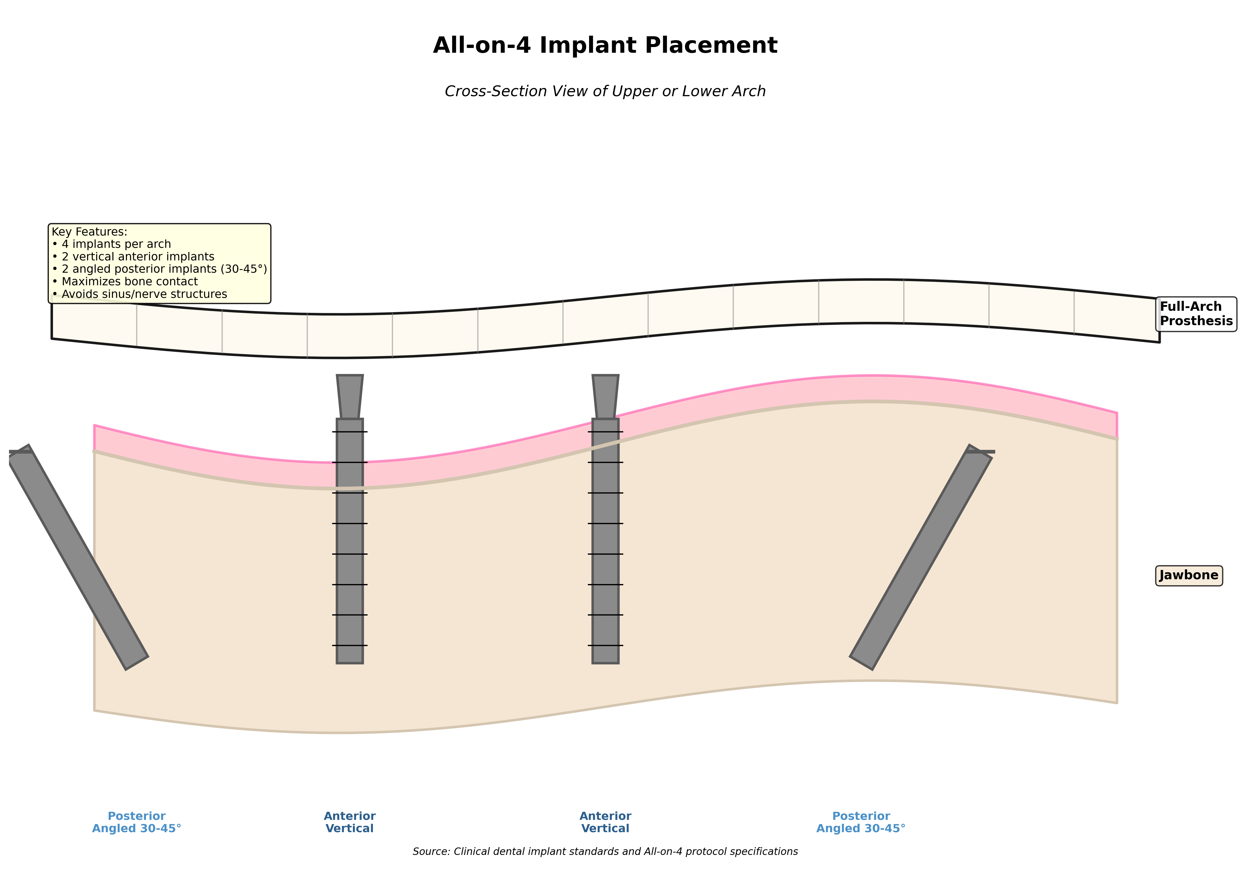 All-on-4 Implant Placement Diagram