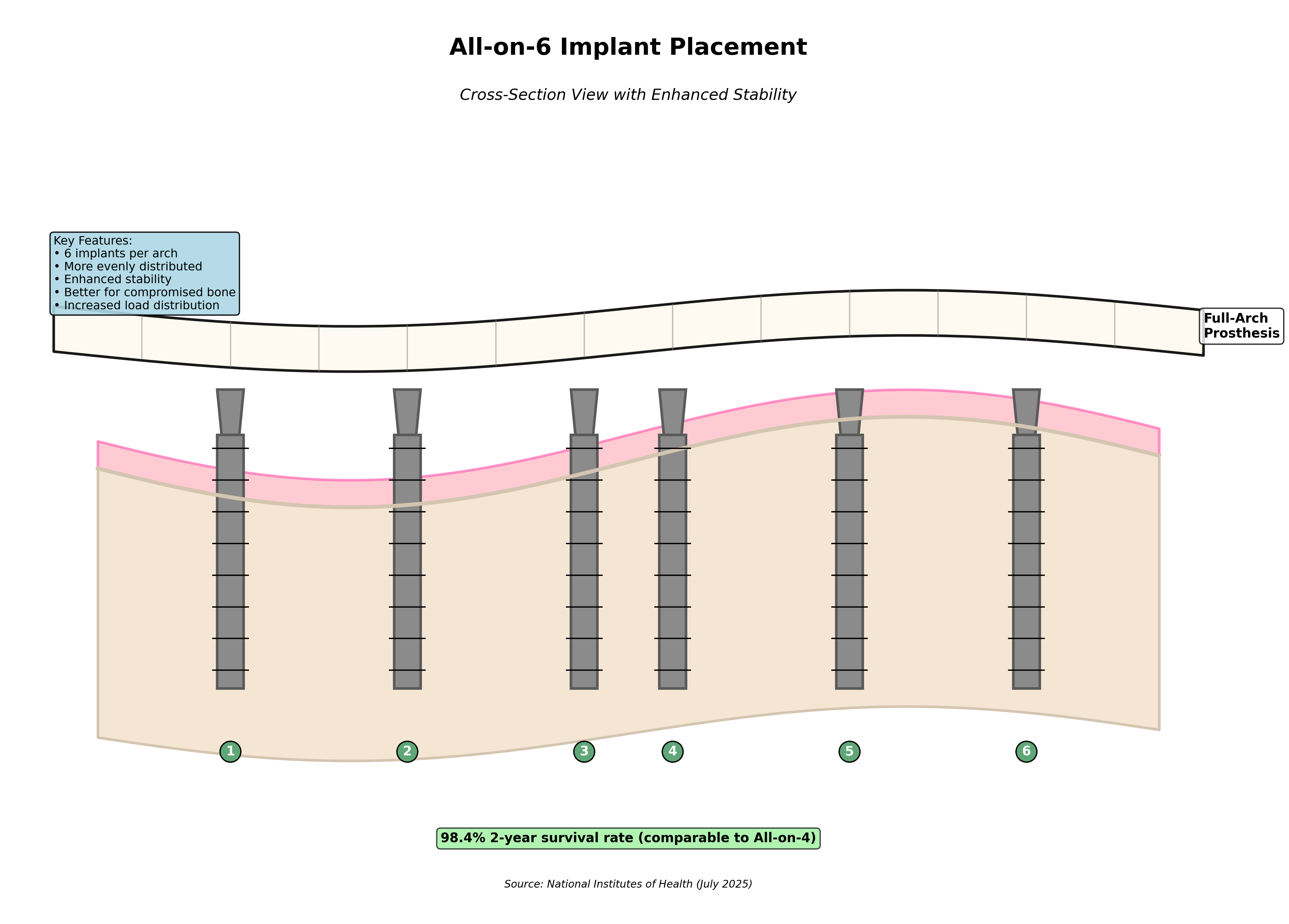 All-on-6 Implant Placement Diagram